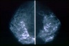 mammogram_top_d[2]